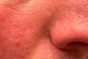 Gros plan d'une peau du visage avec des pores dilatés et de petits creux de cicatrices d'acné